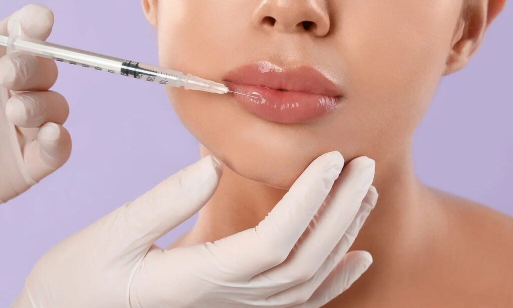 lips, lip filler, filler